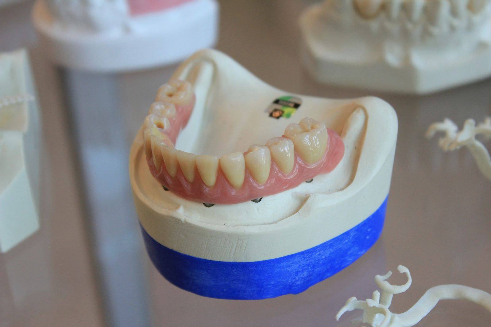 A set of dentures, the starting point for many full-arch patients